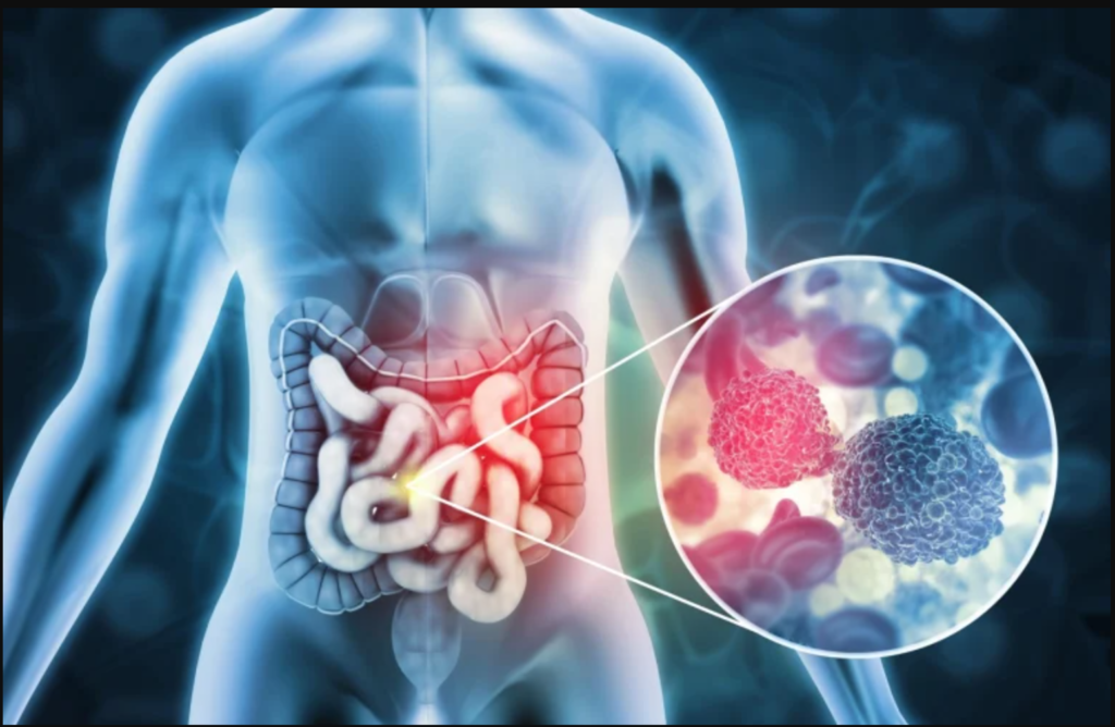 Hareketsizlik, Alkol ve Sigara, Kolon Kanseri Riskini Artırıyor